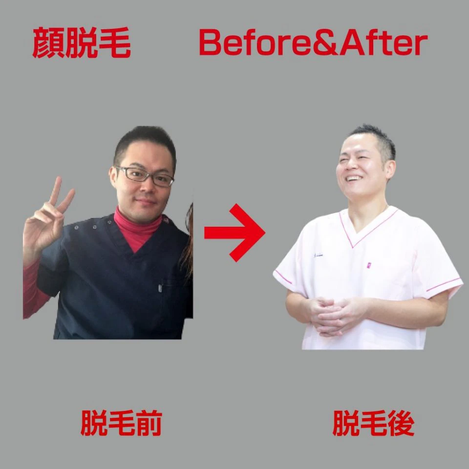 脱毛のビフォーアフター